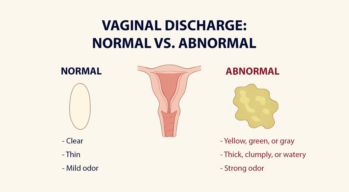 Illustration showing typical and atypical vaginal discharge characteristics